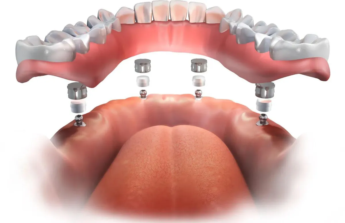 Diagram of a lower implant overdenture with ball attachments, showing four implants in the jaw and the matching sockets inside the denture