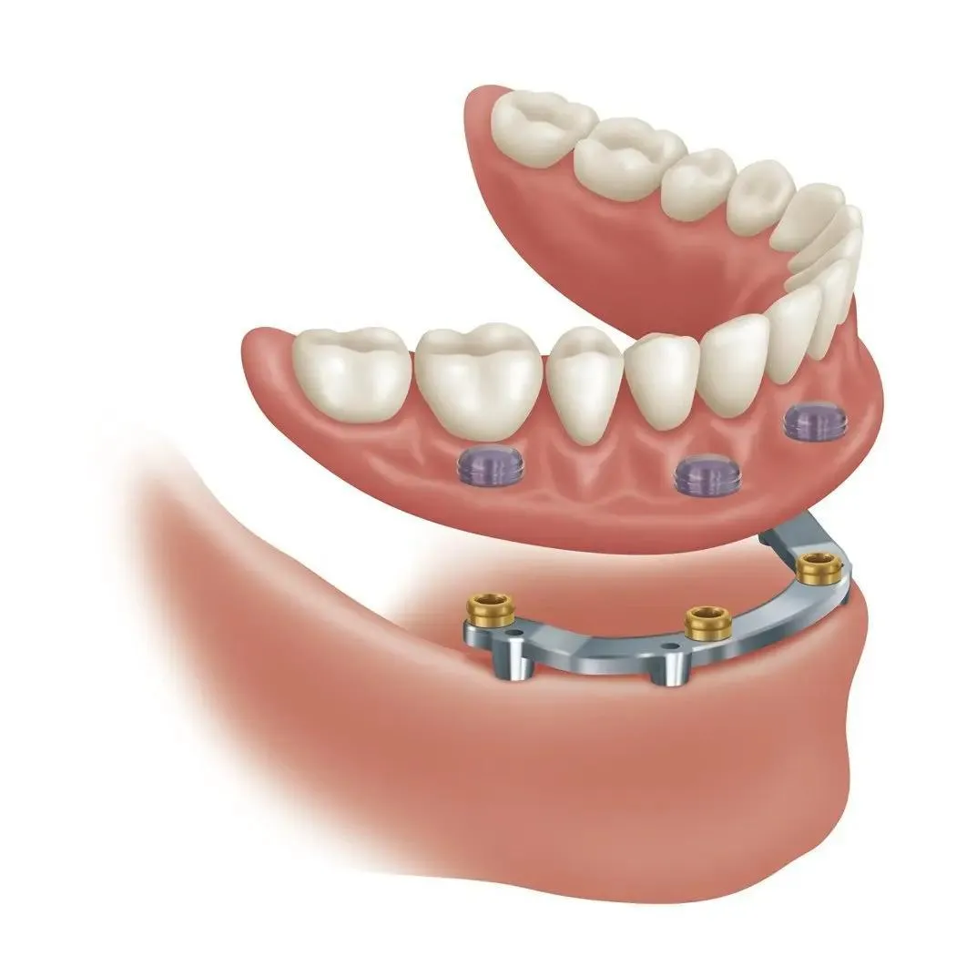 Diagram of a lower implant overdenture with a bar attachment, showing four implants joined by a metal bar and the clips inside the denture that grip it